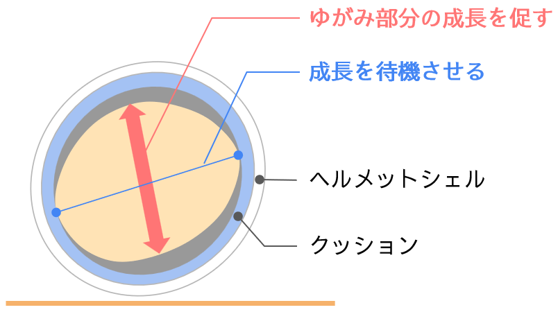 ヘルメット治療の原理